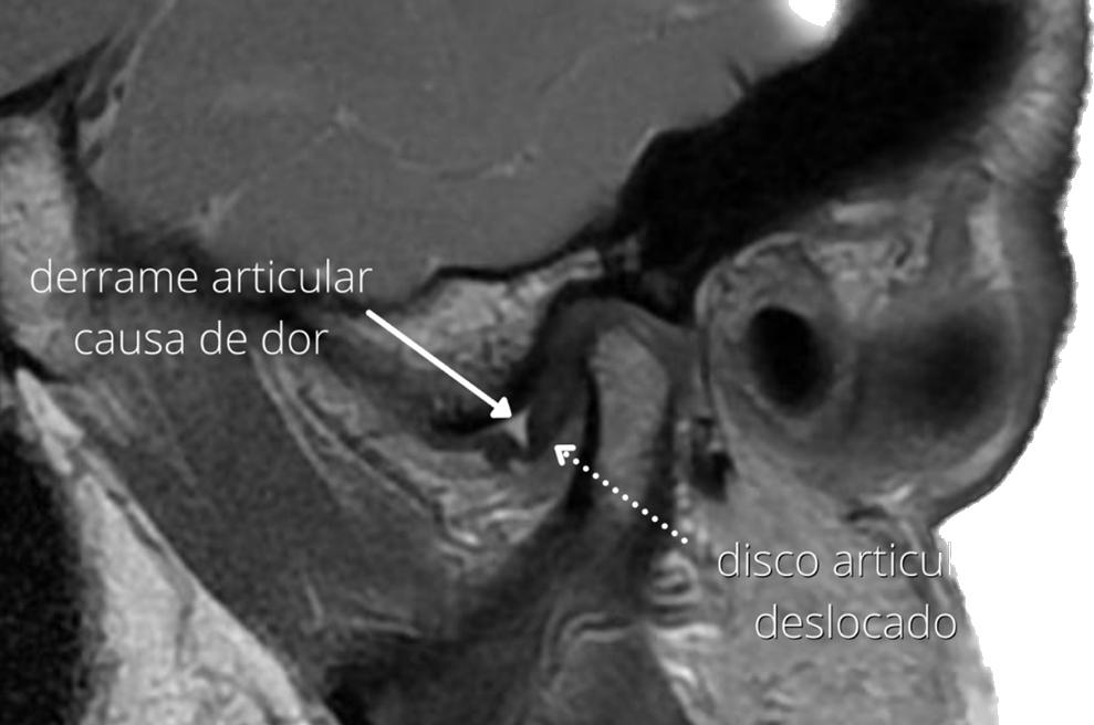 Articulação Temporomandibular - ATM - Rover Ortodontia e ATM - Cascavel